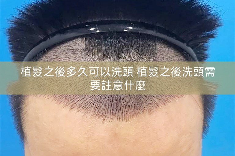 植髮之後多久可以洗頭 植髮之後洗頭需要註意什麼