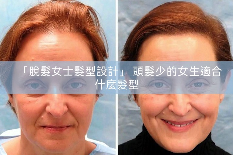 「脫髮女士髮型設計」 頭髮少的女生適合什麼髮型