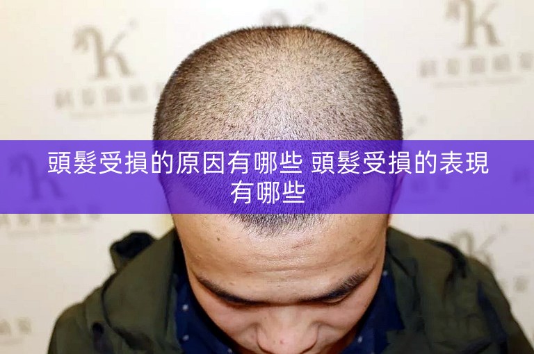 頭髮受損的原因有哪些 頭髮受損的表現有哪些