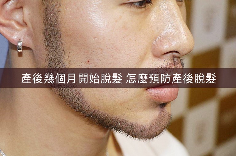 產後幾個月開始脫髮 怎麼預防產後脫髮