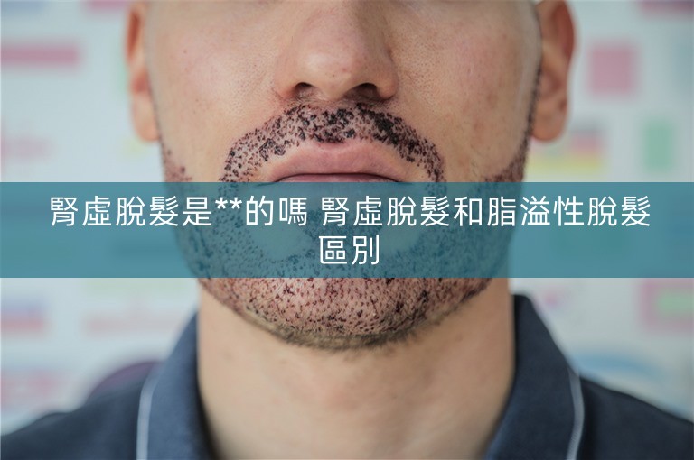 腎虛脫髮是**的嗎 腎虛脫髮和脂溢性脫髮區別