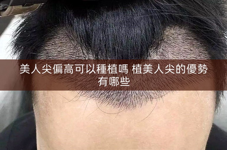 美人尖偏高可以種植嗎 植美人尖的優勢有哪些