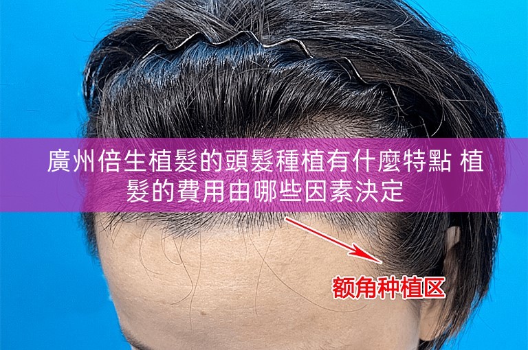 廣州倍生植髮的頭髮種植有什麼特點 植髮的費用由哪些因素決定