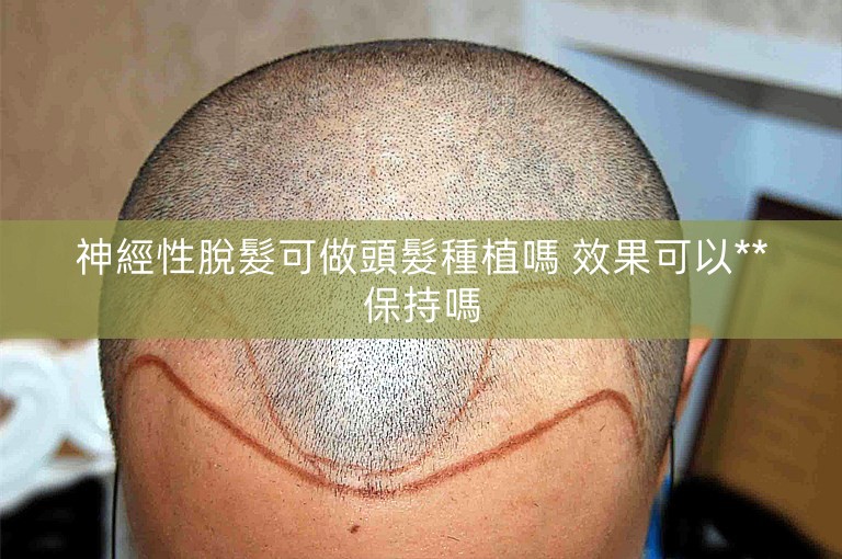 神經性脫髮可做頭髮種植嗎 效果可以**保持嗎 神經性脫髮可做頭髮種植嗎 效果可以**保持嗎