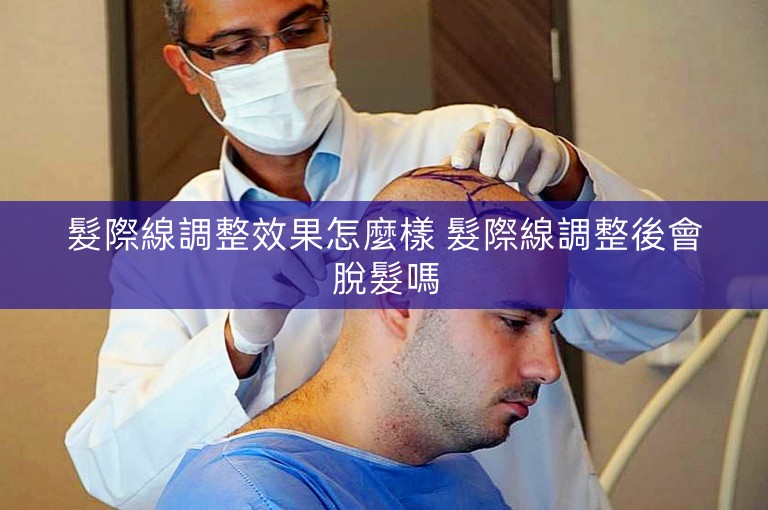 髮際線調整效果怎麼樣 髮際線調整後會脫髮嗎