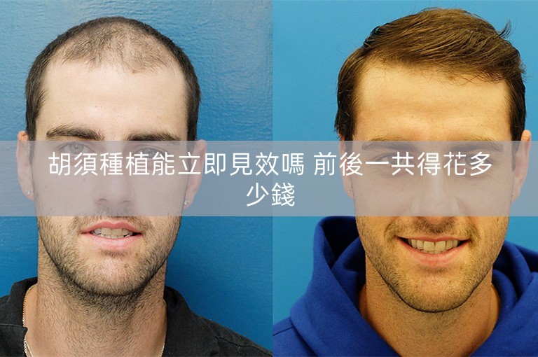 胡須種植能立即見效嗎 前後一共得花多少錢 胡須種植能立即見效嗎 前後一共得花多少錢