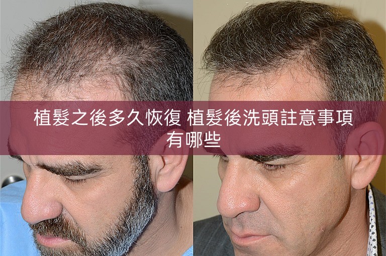 植髮之後多久恢復 植髮後洗頭註意事項有哪些