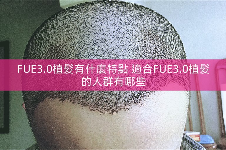 FUE3.0植髮有什麼特點 適合FUE3.0植髮的人群有哪些