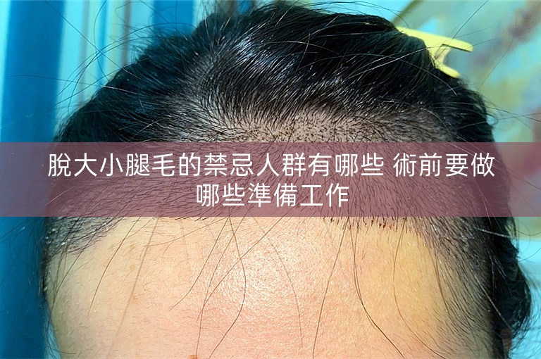 脫大小腿毛的禁忌人群有哪些 術前要做哪些準備工作 脫大小腿毛的禁忌人群有哪些 術前要做哪些準備工作