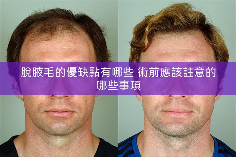 脫腋毛的優缺點有哪些 術前應該註意的哪些事項 脫腋毛的優缺點有哪些 術前應該註意的哪些事項