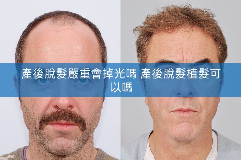 產後脫髮嚴重會掉光嗎 產後脫髮植髮可以嗎 產後脫髮嚴重會掉光嗎 產後脫髮植髮可以嗎