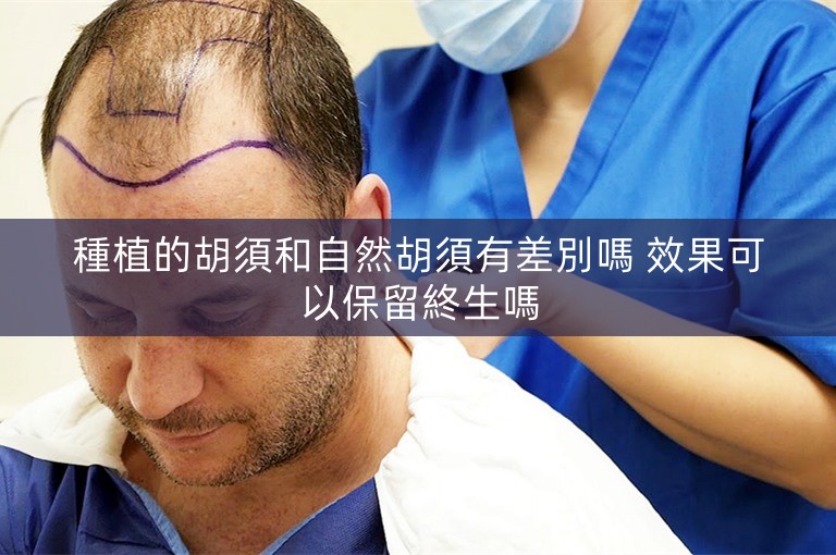 種植的胡須和自然胡須有差別嗎 效果可以保留終生嗎