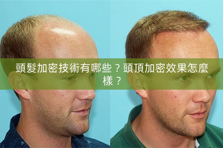 頭髮加密技術有哪些？頭頂加密效果怎麼樣？