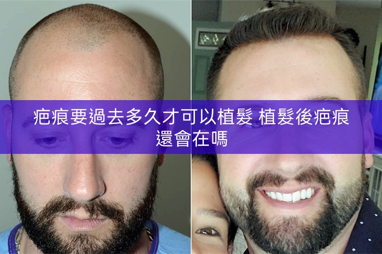 疤痕要過去多久才可以植髮 植髮後疤痕還會在嗎
