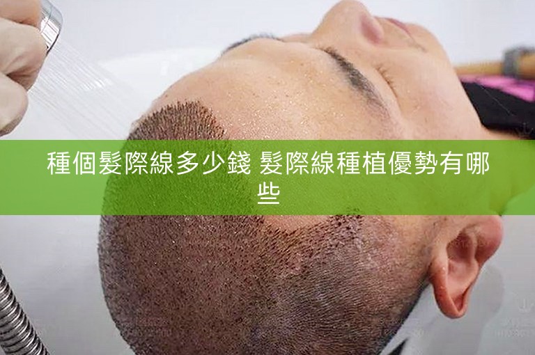 種個髮際線多少錢 髮際線種植優勢有哪些