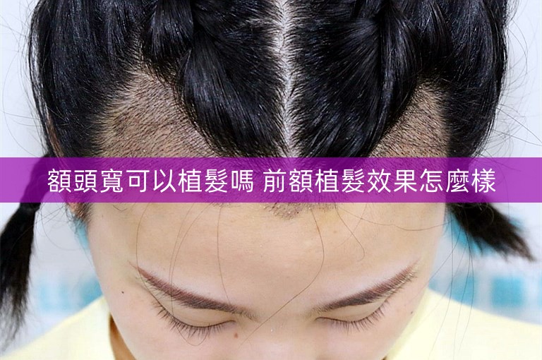額頭寬可以植髮嗎 前額植髮效果怎麼樣