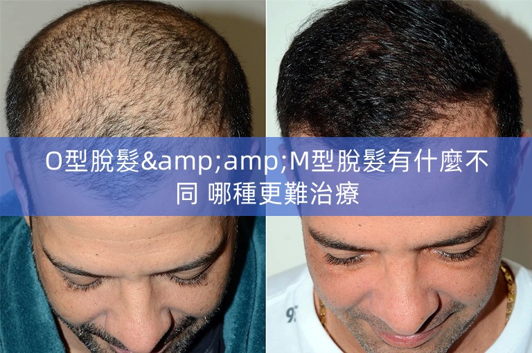 O型脫髮&amp;M型脫髮有什麼不同 哪種更難治療
