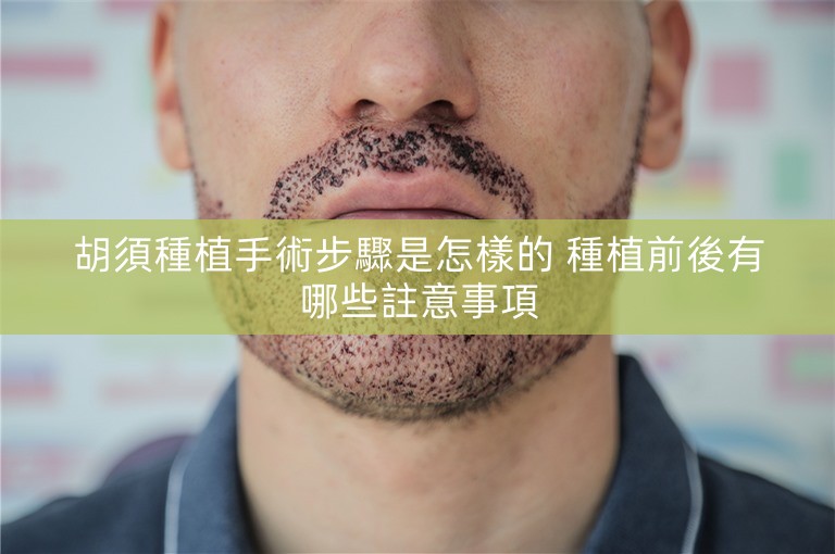 胡須種植手術步驟是怎樣的 種植前後有哪些註意事項