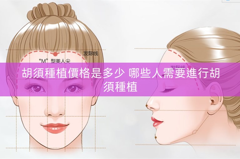 胡須種植價格是多少 哪些人需要進行胡須種植