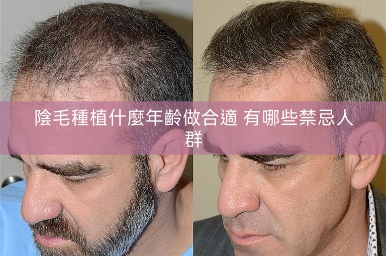 陰毛種植什麼年齡做合適 有哪些禁忌人群