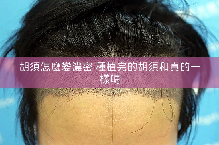 胡須怎麼變濃密 種植完的胡須和真的一樣嗎 胡須怎麼變濃密 種植完的胡須和真的一樣嗎