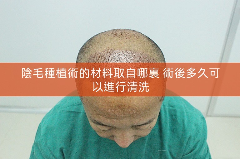 陰毛種植術的材料取自哪裏 術後多久可以進行清洗 陰毛種植術的材料取自哪裏 術後多久可以進行清洗