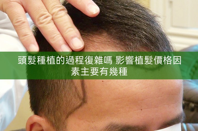 頭髮種植的過程復雜嗎 影響植髮價格因素主要有幾種