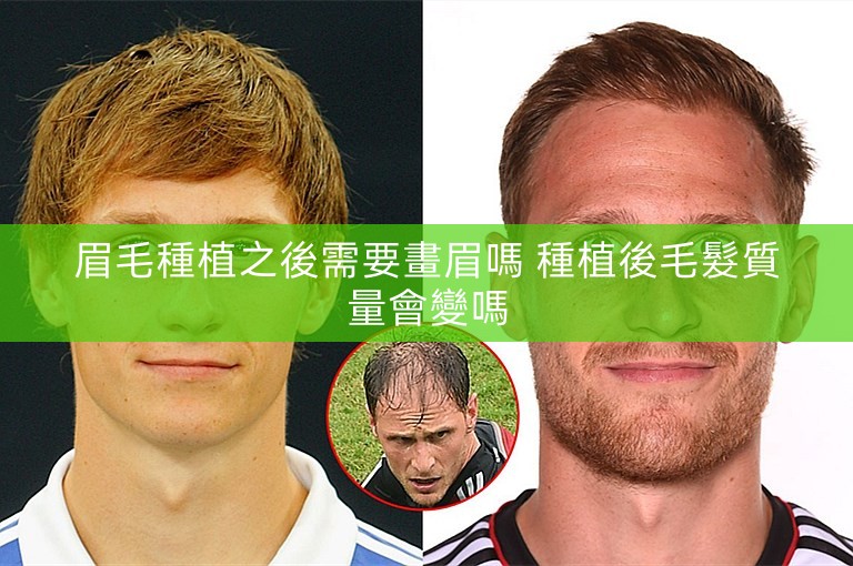 眉毛種植之後需要畫眉嗎 種植後毛髮質量會變嗎