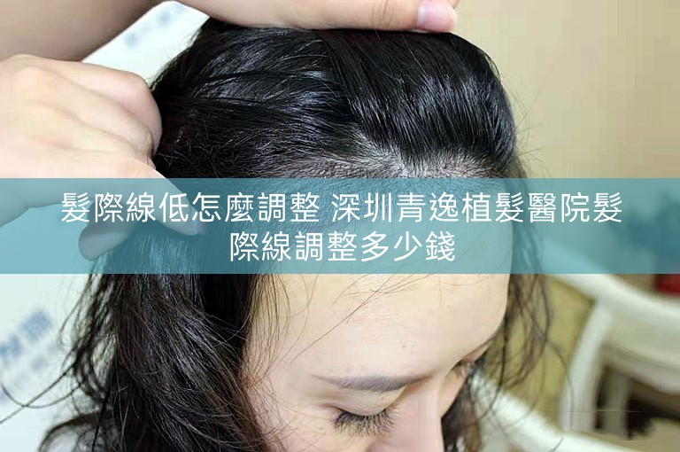 髮際線低怎麼調整 深圳青逸植髮醫院髮際線調整多少錢