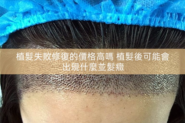 植髮失敗修復的價格高嗎 植髮後可能會出現什麼並髮癥