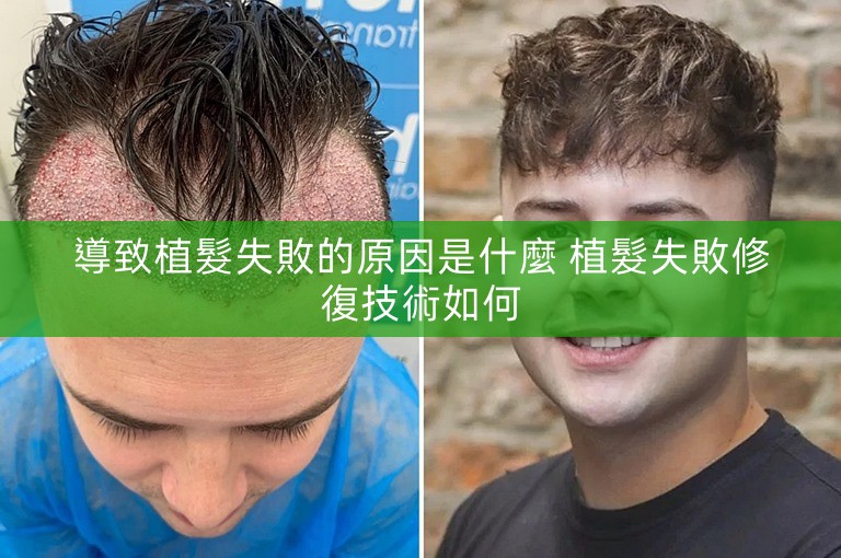 導致植髮失敗的原因是什麼 植髮失敗修復技術如何
