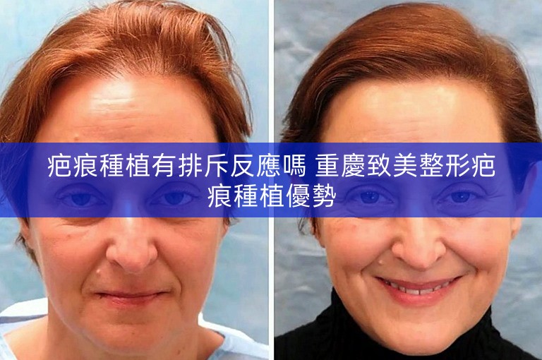 疤痕種植有排斥反應嗎 重慶致美整形疤痕種植優勢