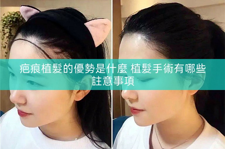疤痕植髮的優勢是什麼 植髮手術有哪些註意事項