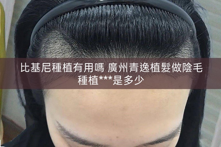 比基尼種植有用嗎 廣州青逸植髮做陰毛種植***是多少