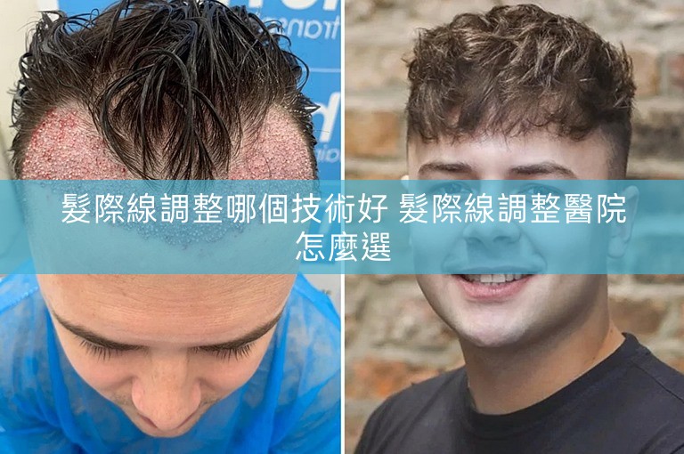 髮際線調整哪個技術好 髮際線調整醫院怎麼選