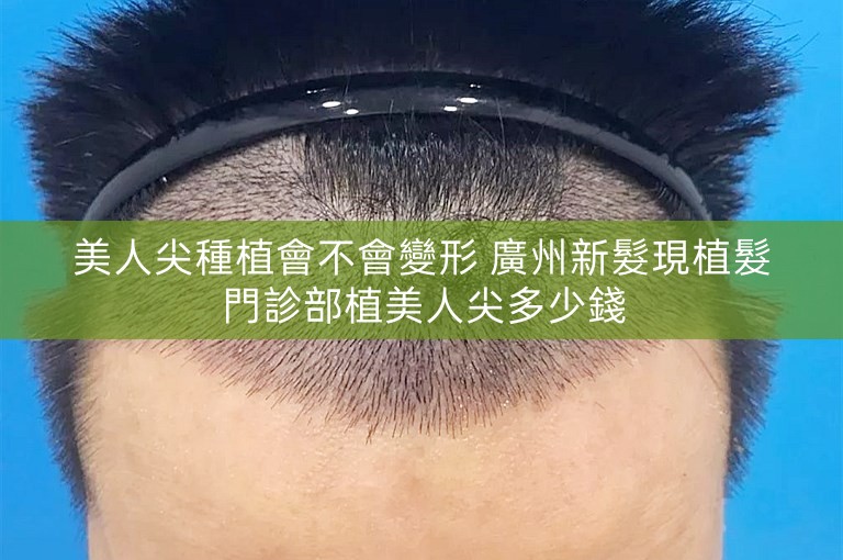美人尖種植會不會變形 廣州新髮現植髮門診部植美人尖多少錢