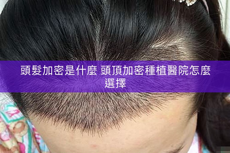頭髮加密是什麼 頭頂加密種植醫院怎麼選擇