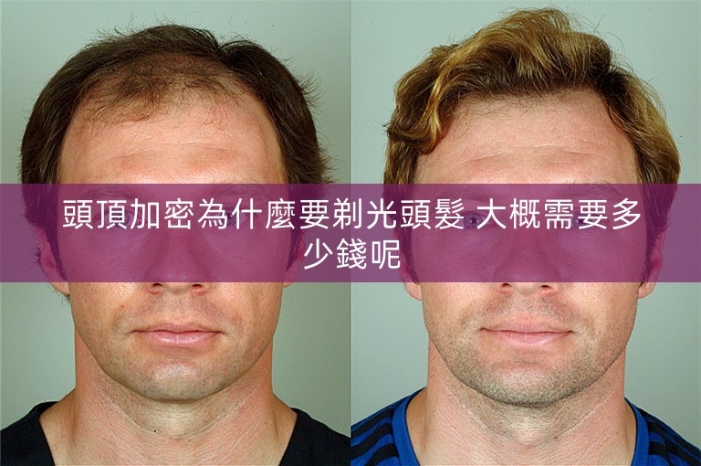頭頂加密為什麼要剃光頭髮 大概需要多少錢呢