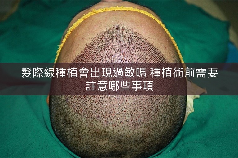 髮際線種植會出現過敏嗎 種植術前需要註意哪些事項