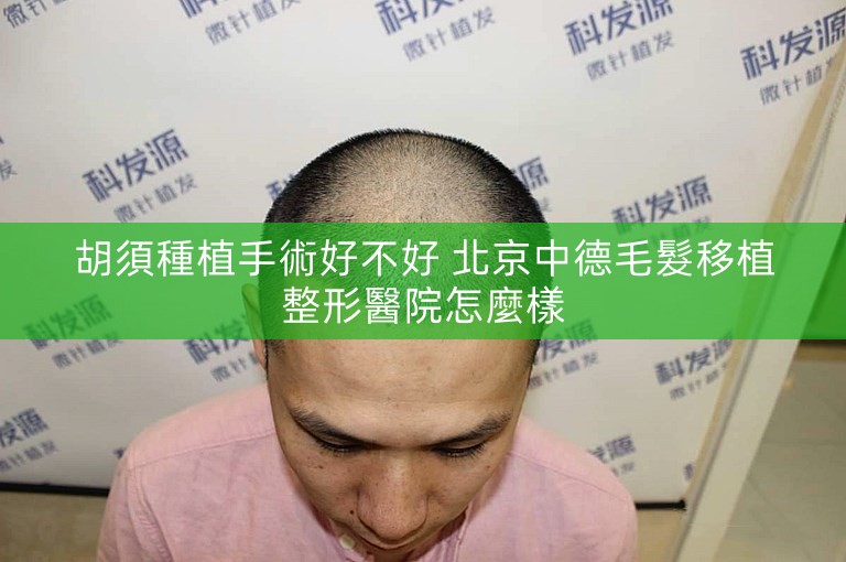 胡須種植手術好不好 北京中德毛髮移植整形醫院怎麼樣