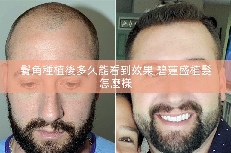 鬢角種植後多久能看到效果 碧蓮盛植髮怎麼樣