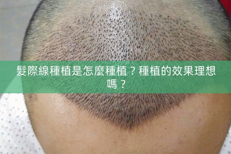 髮際線種植是怎麼種植？種植的效果理想嗎？