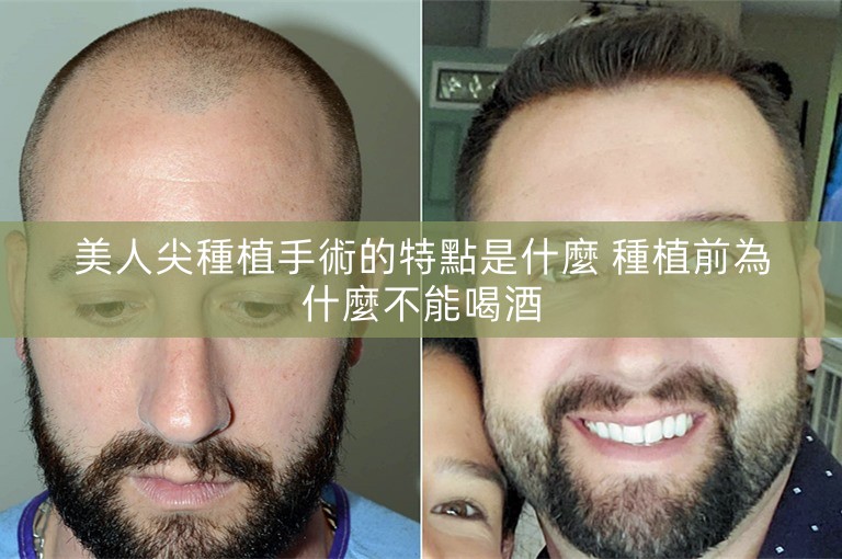美人尖種植手術的特點是什麼 種植前為什麼不能喝酒
