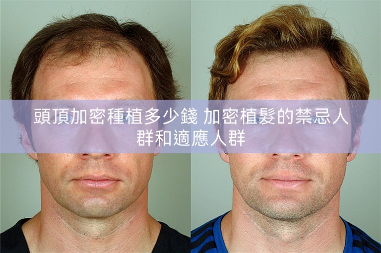 頭頂加密種植多少錢 加密植髮的禁忌人群和適應人群