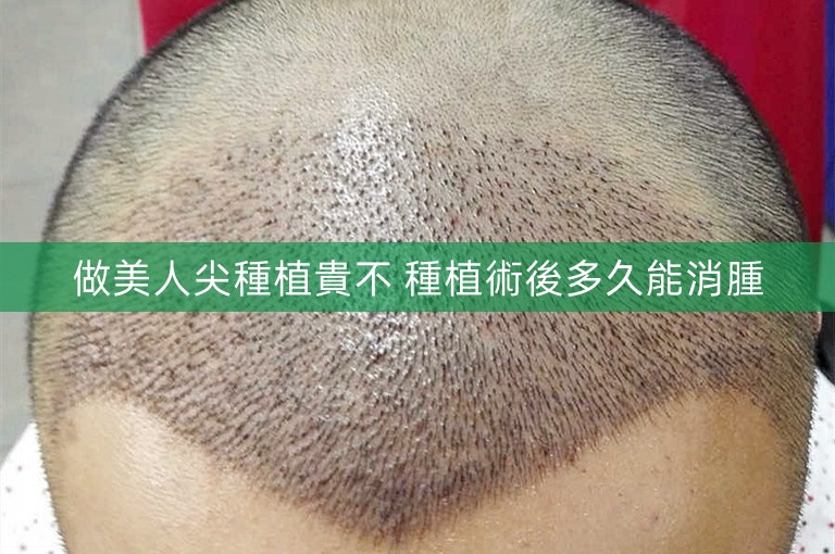 做美人尖種植貴不 種植術後多久能消腫