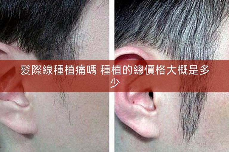 髮際線種植痛嗎 種植的總價格大概是多少