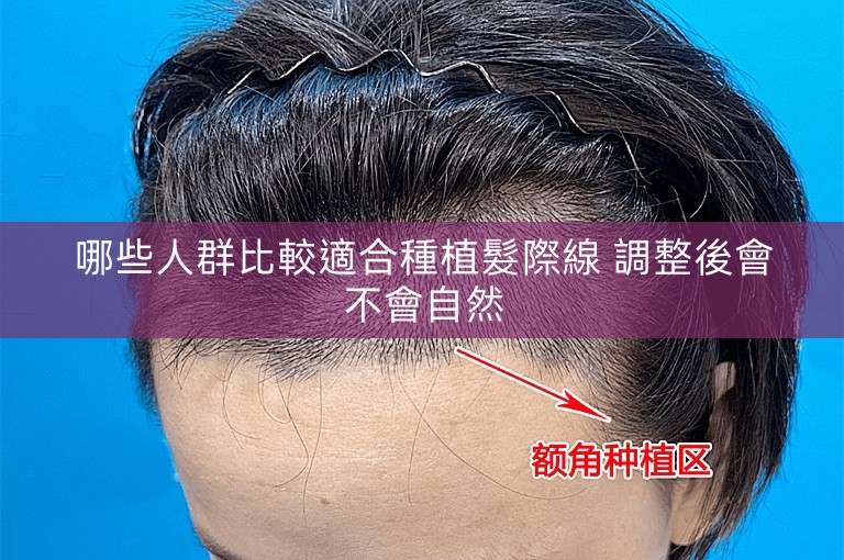 哪些人群比較適合種植髮際線 調整後會不會自然