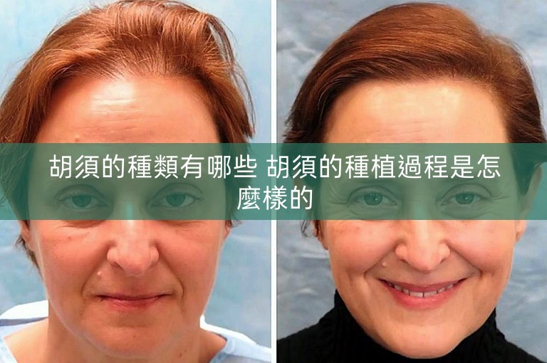 胡須的種類有哪些 胡須的種植過程是怎麼樣的 胡須的種類有哪些 胡須的種植過程是怎麼樣的