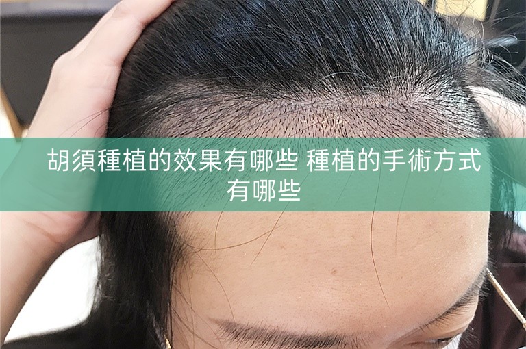 胡須種植的效果有哪些 種植的手術方式有哪些