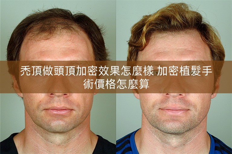 禿頂做頭頂加密效果怎麼樣 加密植髮手術價格怎麼算